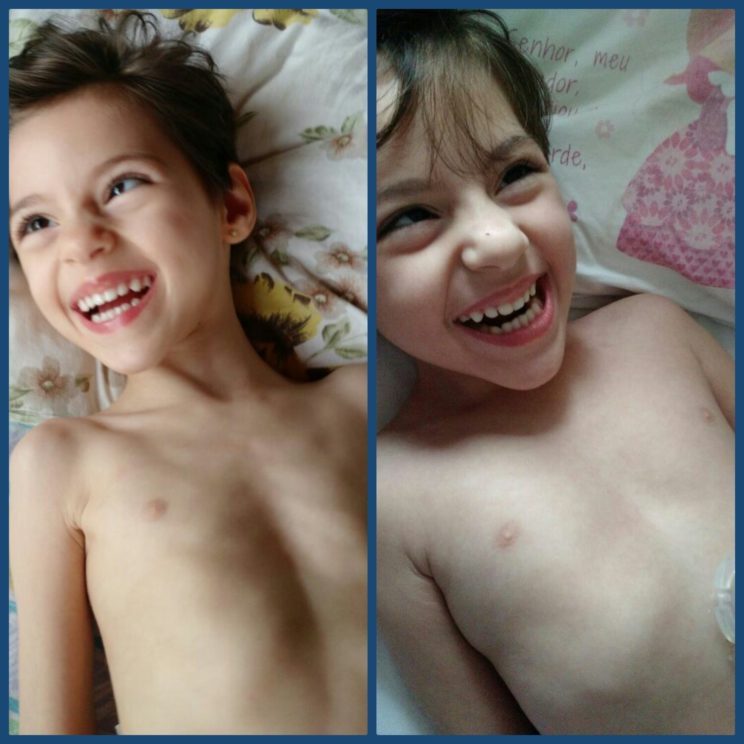 antes e depois da gastro